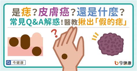 長毛痣|是痣？皮膚癌？還是什麼？常見Q&A解惑！醫教揪出「假的痣」